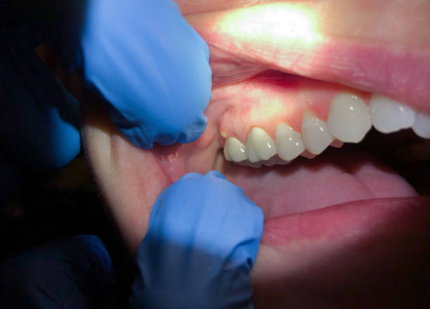 Best Emergency Dentist for Lost Fillings or Crowns in Mount Ida, AR
