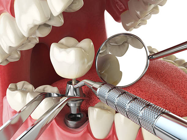 Best Emergency Root Canal Treatment in Mount Ida, AR